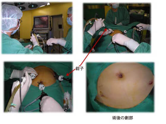 腹腔鏡手術の様子
