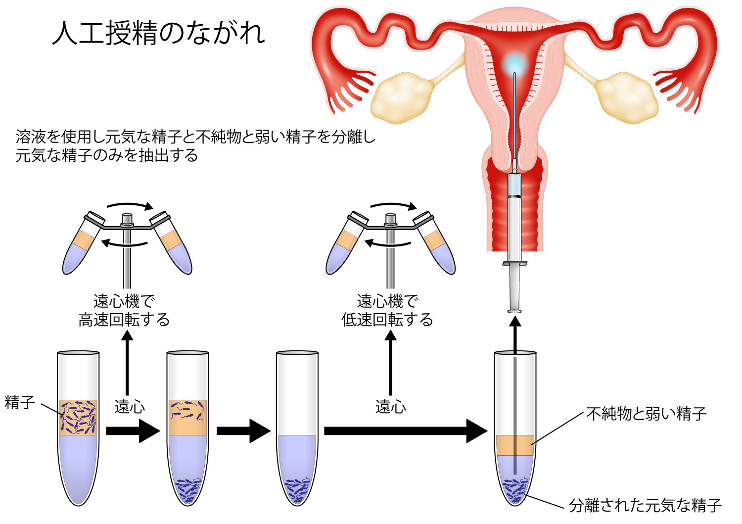 子宮口精子注射画像 