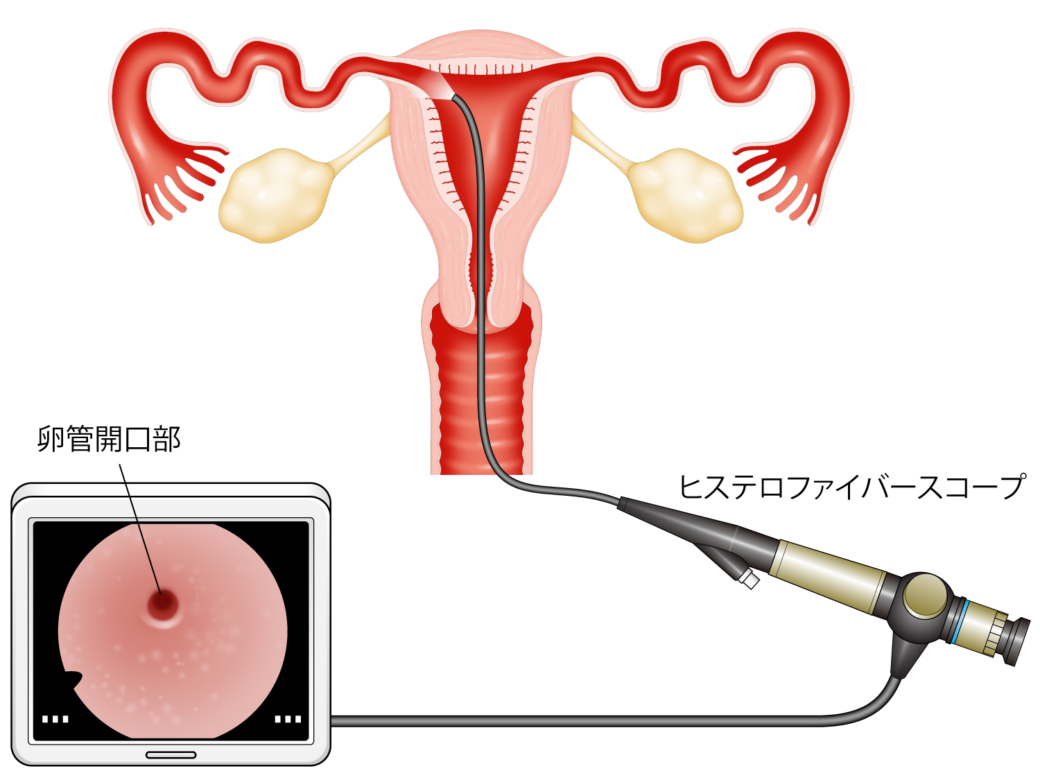 子宮鏡検査の図
